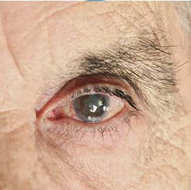 Cataract Surgery in Utah